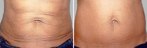 exilis-banda-tummy-495x1621