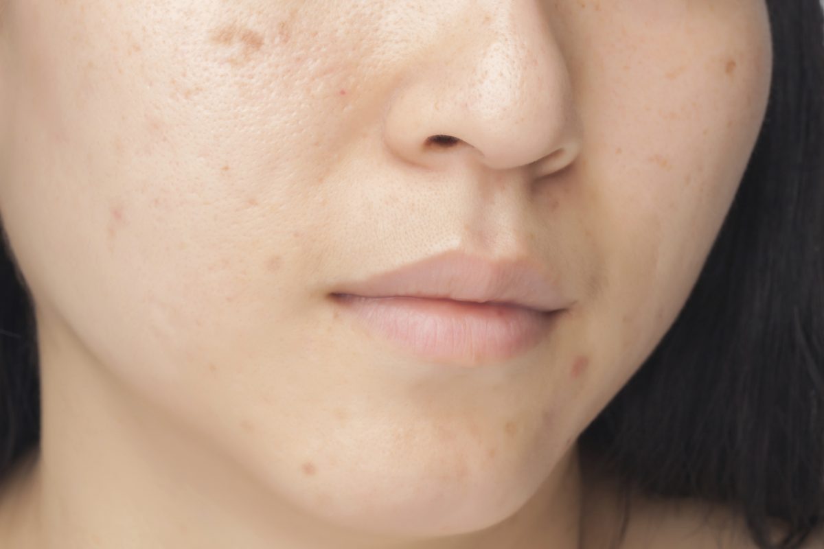Acne Reversal for Back to School