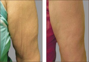 exilis-before-arms-sagging-skin-after-arms-smooth