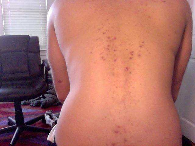 Back Acne Scarring Fix